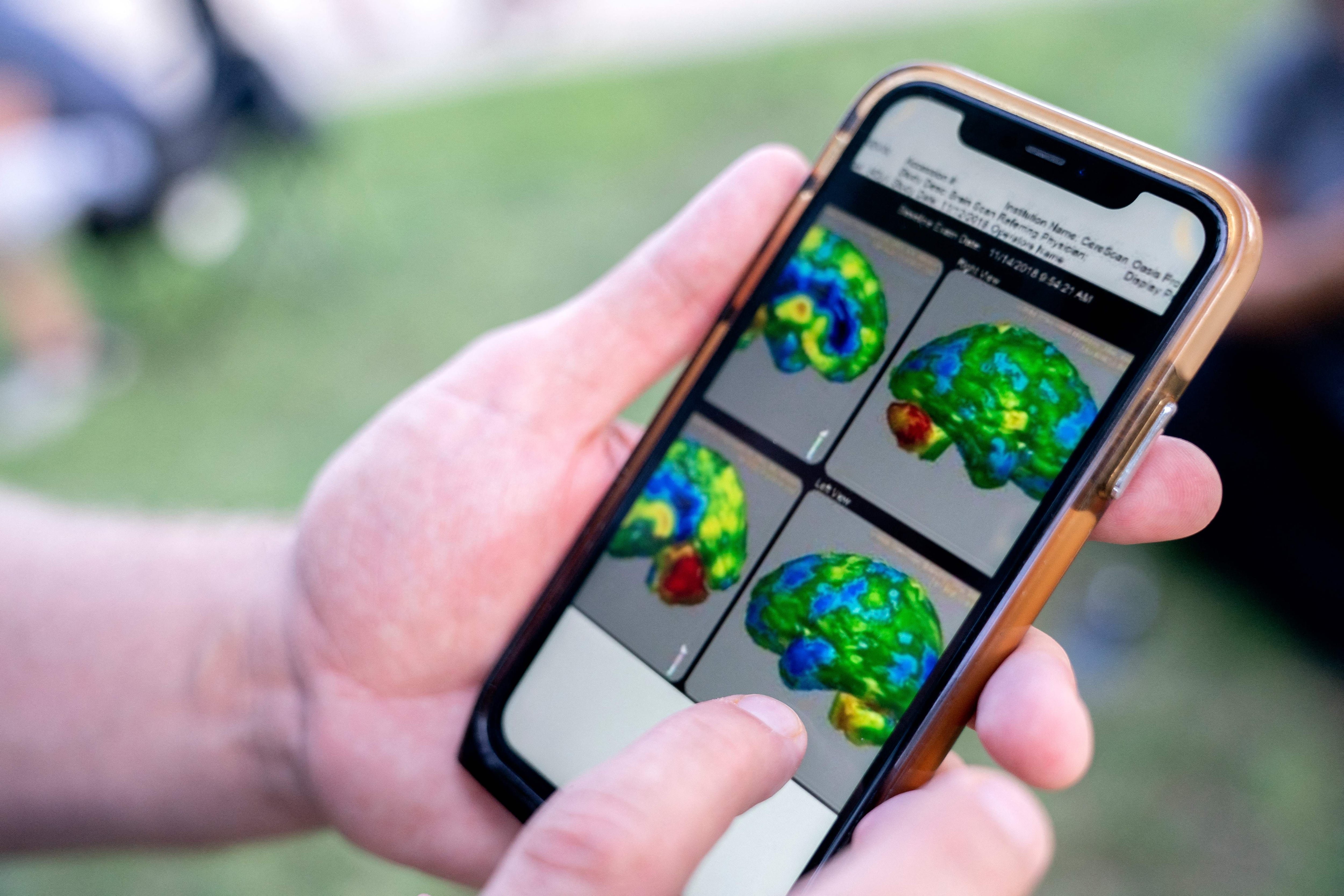 An Iraq and Afghanistan war veteran shows brain scans from medical procedures he had done, outside the US Capitol in Washington, D.C., on August 1, 2022.